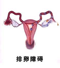 排卵障碍需要做哪些检查